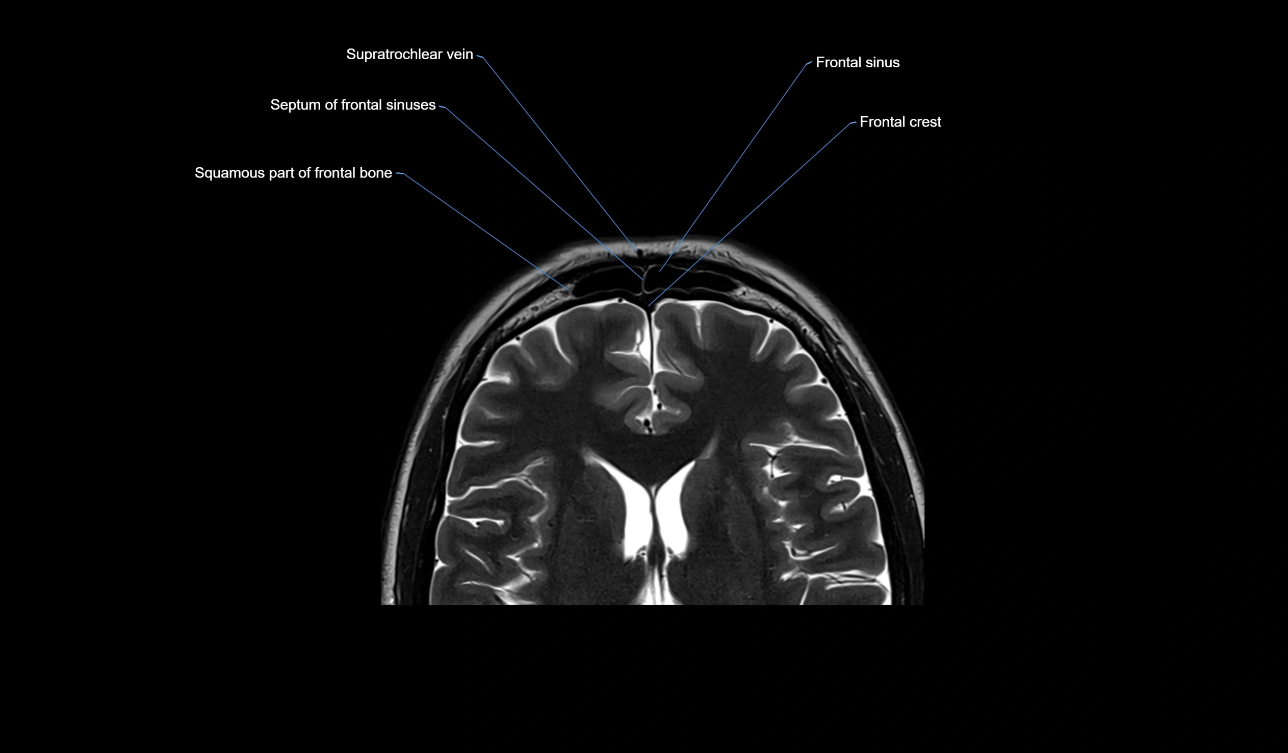 MRI face & paranasal sinuses(PNS) labelled  axial  cross sectional anatomy 3T radiology  image -00032.webp